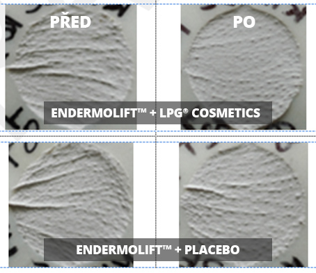 Výsledky působení endermologie face a LPG Cosmetics