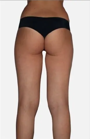 Pokožka po sérii ošetření endermologie®