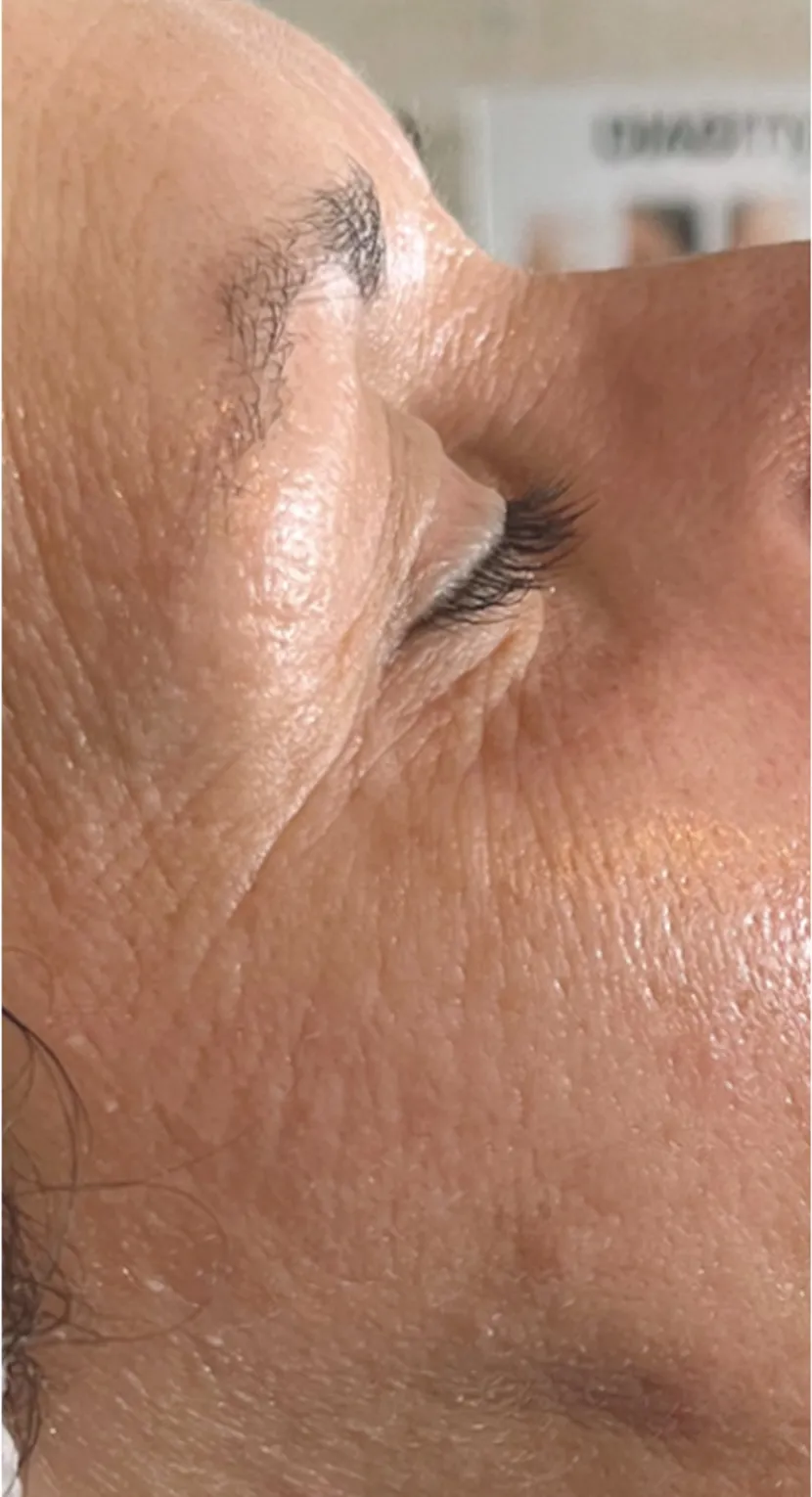 Oční okolí po 1 ošetření endermologie® face