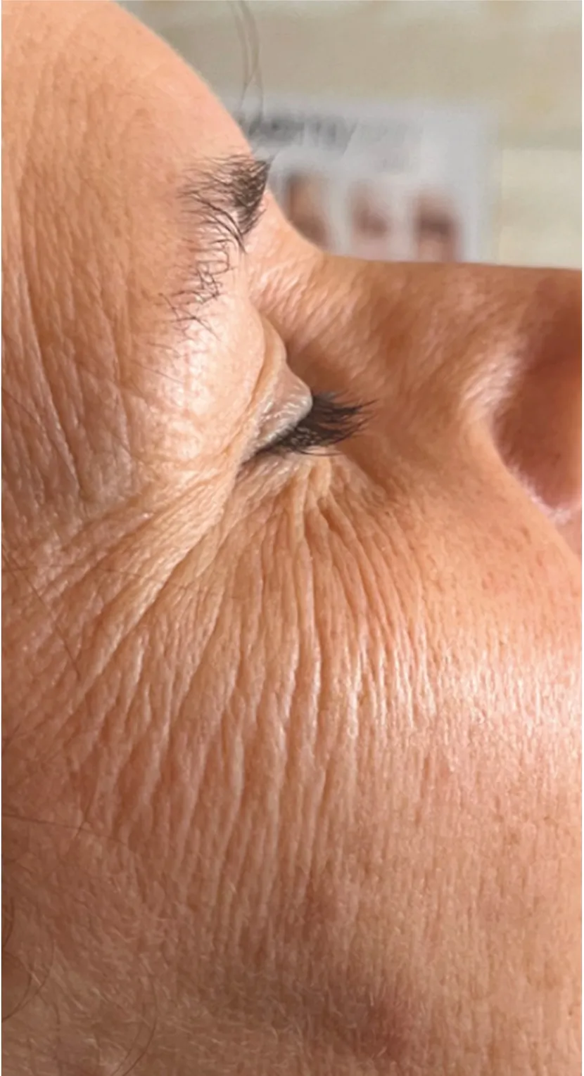 Oční okolí a vrásky před ošetřením endermologie® face